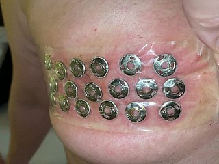 Loại bỏ các đinh bấm từ bowels