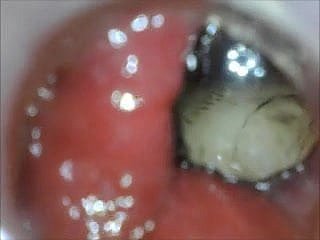 anal endoscope aggravation play foreign inner