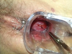 Mirena Spirale ziehen reasoning IUD IUP entfernen